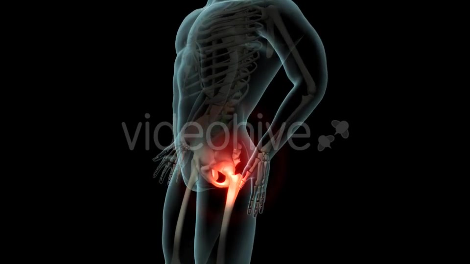 Lateral Hip Pain Videohive 21246229 Motion Graphics Image 3