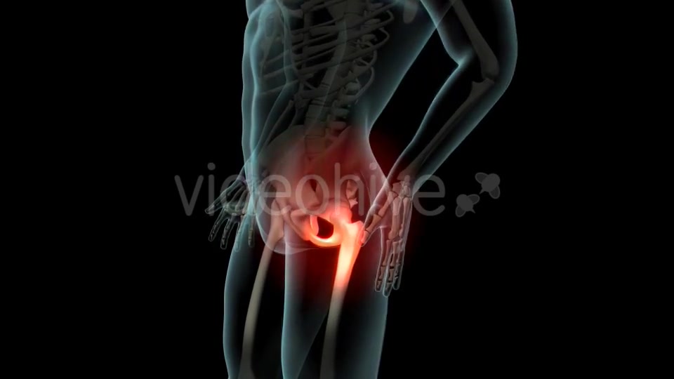 Lateral Hip Pain Videohive 21246229 Motion Graphics Image 4