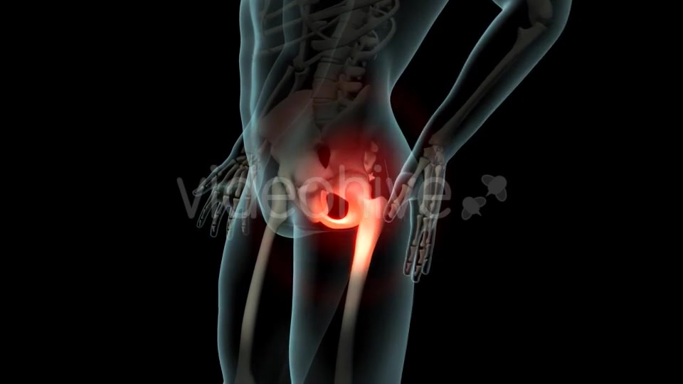 Lateral Hip Pain Videohive 21246229 Motion Graphics Image 5
