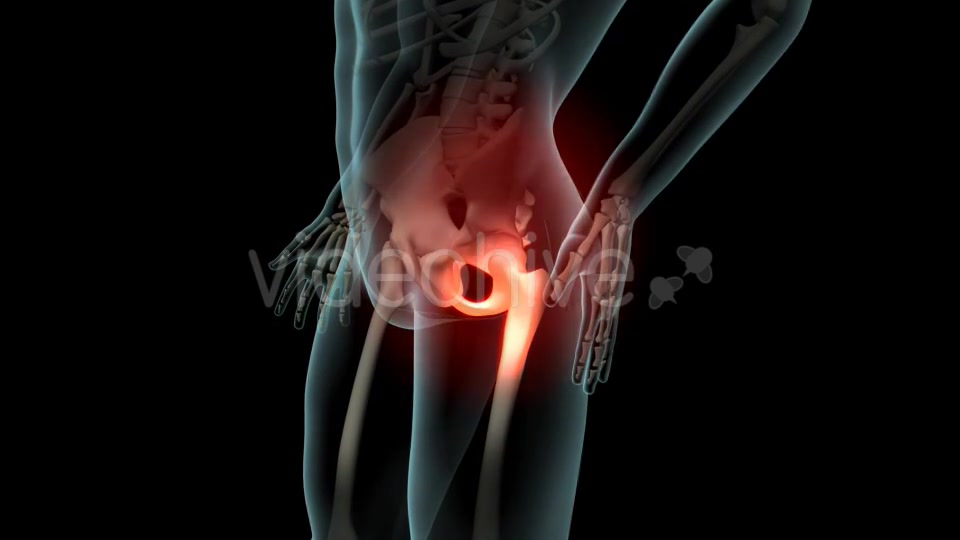 Lateral Hip Pain Videohive 21246229 Motion Graphics Image 6