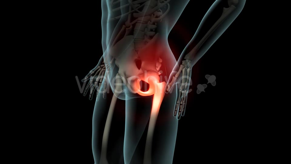 Lateral Hip Pain Videohive 21246229 Motion Graphics Image 7