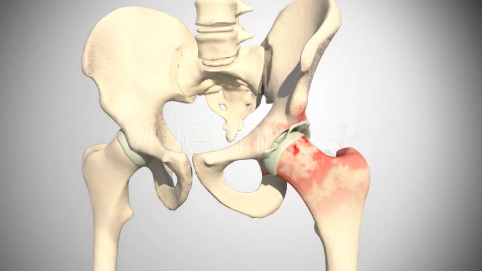 Lesion Of The Acetabular Labrum Hip Videohive 14941410 Motion Graphics Image 10