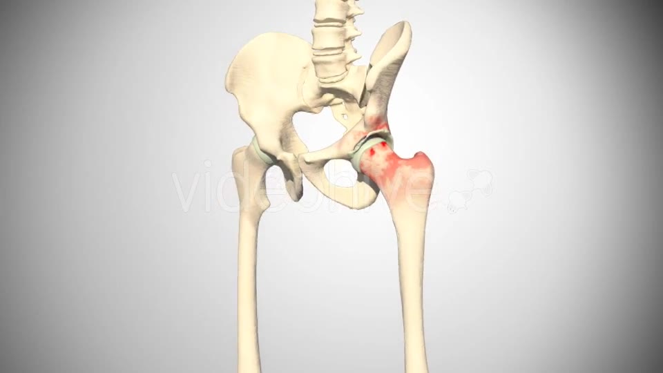 Lesion Of The Acetabular Labrum Hip Videohive 14941410 Motion Graphics Image 11