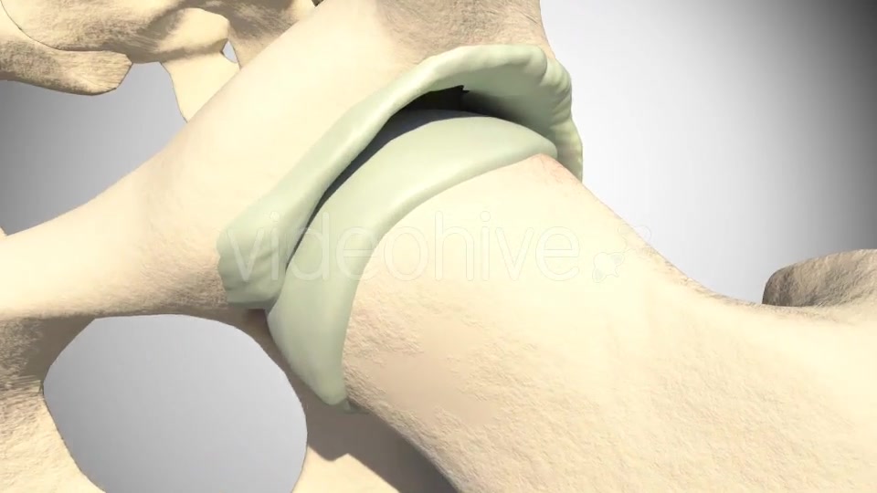 Lesion Of The Acetabular Labrum Hip Videohive 14941410 Motion Graphics Image 4
