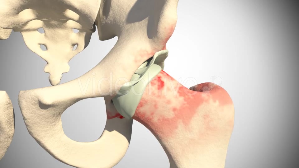 Lesion Of The Acetabular Labrum Hip Videohive 14941410 Motion Graphics Image 9