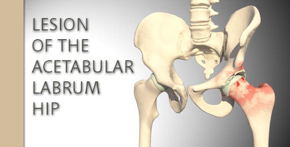 Lesion Of The Acetabular Labrum Hip - Videohive 14941410 Download