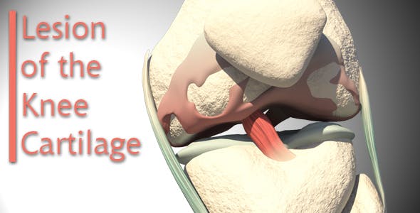 Lesion Of The Knee Cartilage - Download 14813479 Videohive