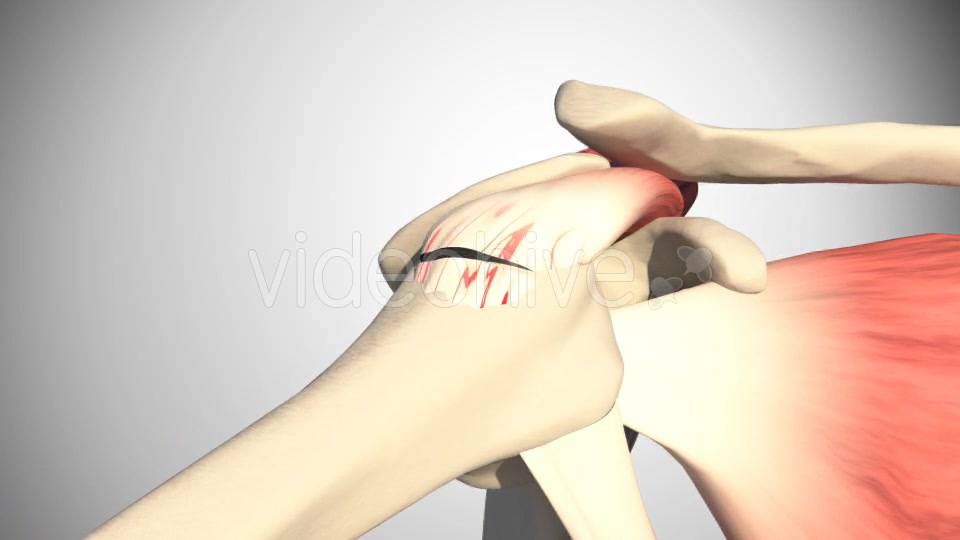 Lesion Of The Rotator Cuff Videohive 16084951 Motion Graphics Image 6