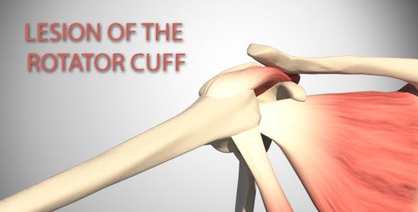 Lesion Of The Rotator Cuff - 16084951 Videohive Download