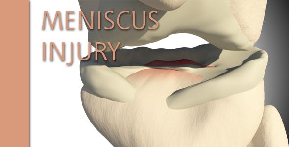 Meniscus Injury - Videohive 15024990 Download