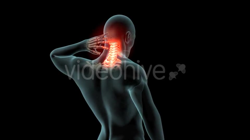 Neck Pain Videohive 21249692 Motion Graphics Image 2