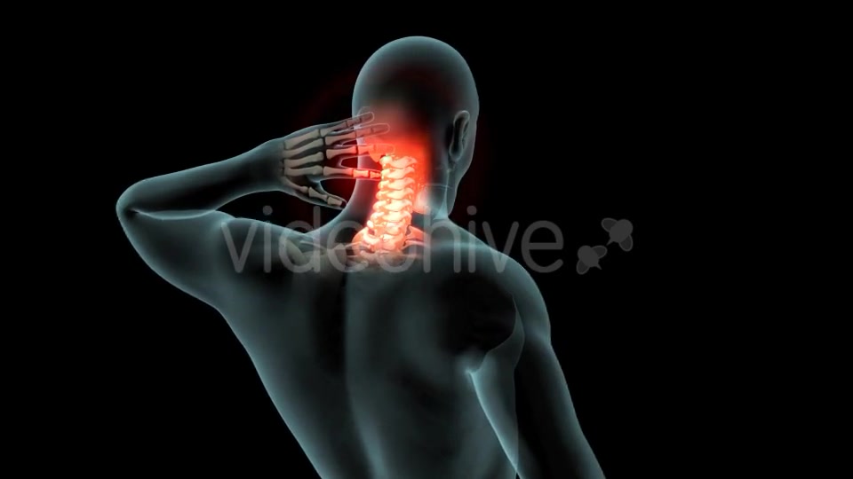 Neck Pain Videohive 21249692 Motion Graphics Image 3