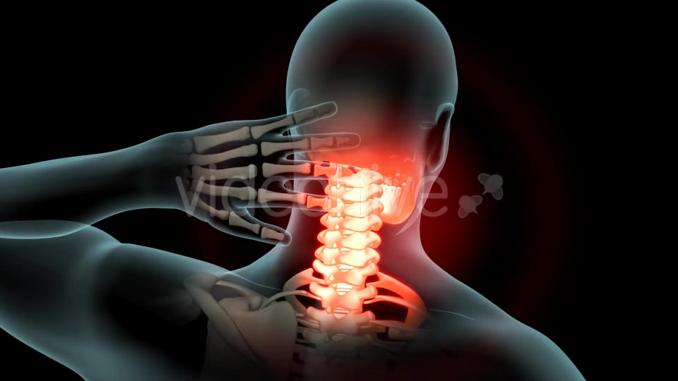 Neck Pain Videohive 21249692 Motion Graphics Image 7