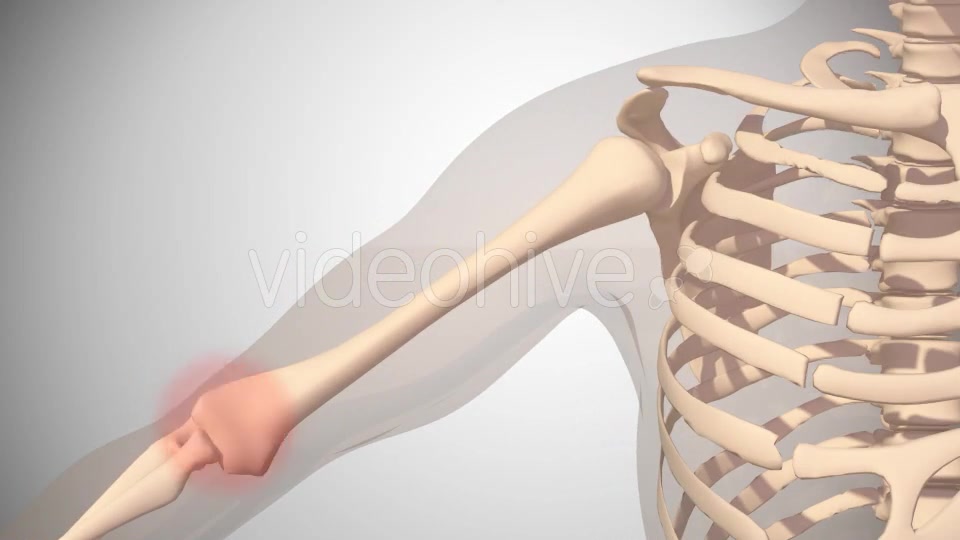 Polymialgya Rheumatica Videohive 16092049 Motion Graphics Image 4