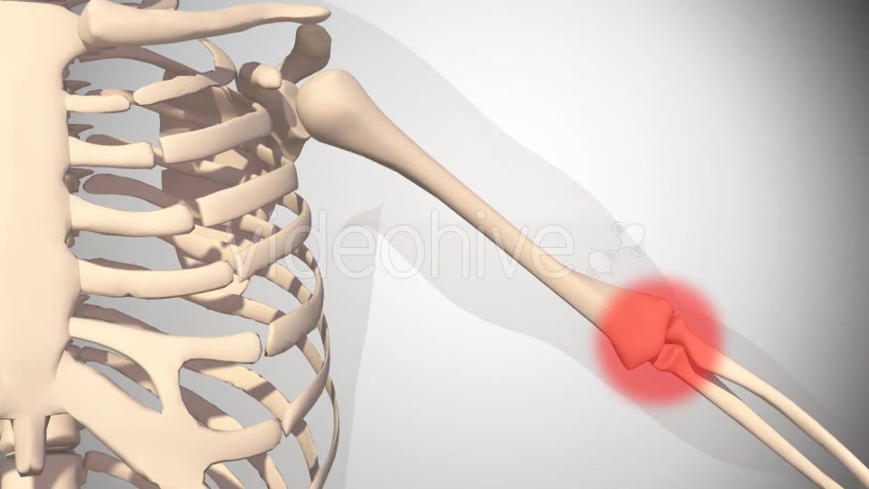 Polymialgya Rheumatica Videohive 16092049 Motion Graphics Image 6