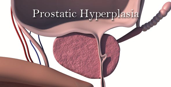 Prostatic Hyperplasia - 18342556 Videohive Download