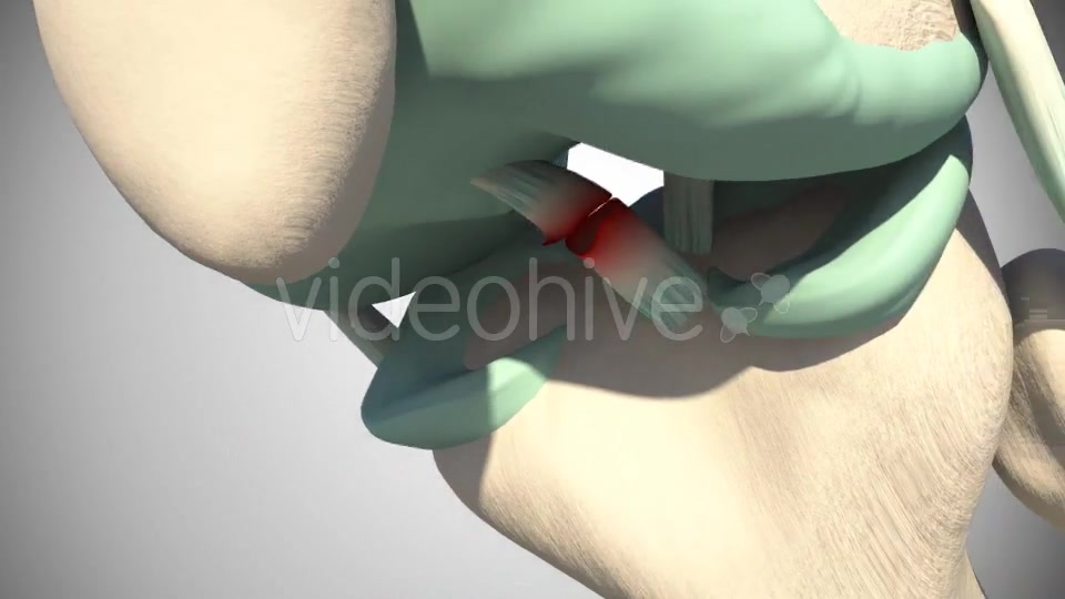 Rupture Of The Anterior Cruciate Ligament Videohive 16097377 Motion Graphics Image 10