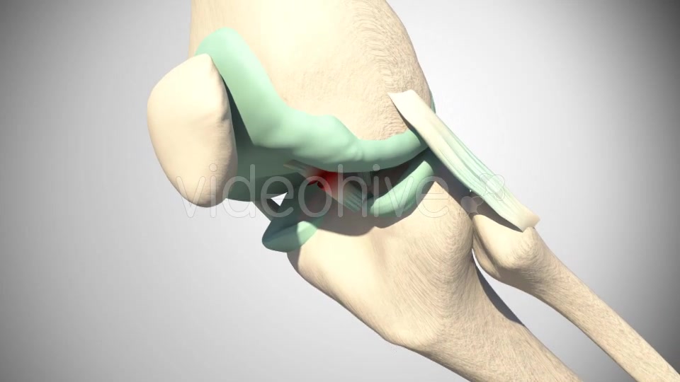 Rupture Of The Anterior Cruciate Ligament Videohive 16097377 Motion Graphics Image 11