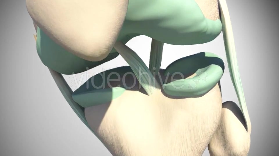 Rupture Of The Anterior Cruciate Ligament Videohive 16097377 Motion Graphics Image 6