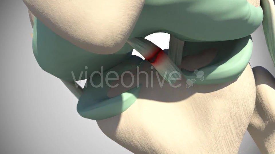 Rupture Of The Anterior Cruciate Ligament Videohive 16097377 Motion Graphics Image 8