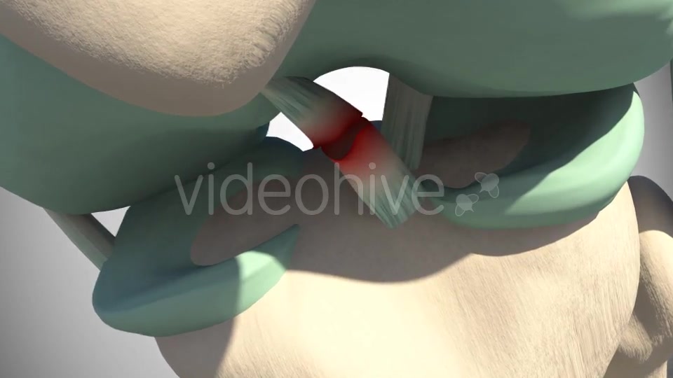 Rupture Of The Anterior Cruciate Ligament Videohive 16097377 Motion Graphics Image 9