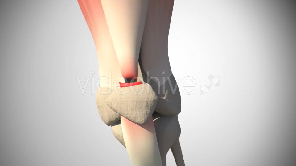 Rupture Of The Quadriceps Tendon Videohive 16093760 Motion Graphics Image 6