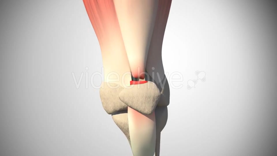 Rupture Of The Quadriceps Tendon Videohive 16093760 Motion Graphics Image 7