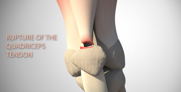 Rupture Of The Quadriceps Tendon - Videohive Download 16093760
