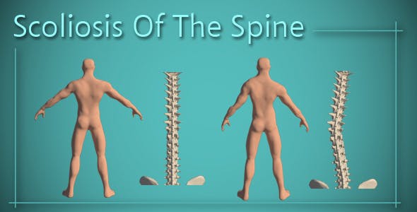 Scoliosis Of The Spine - 14408192 Videohive Download