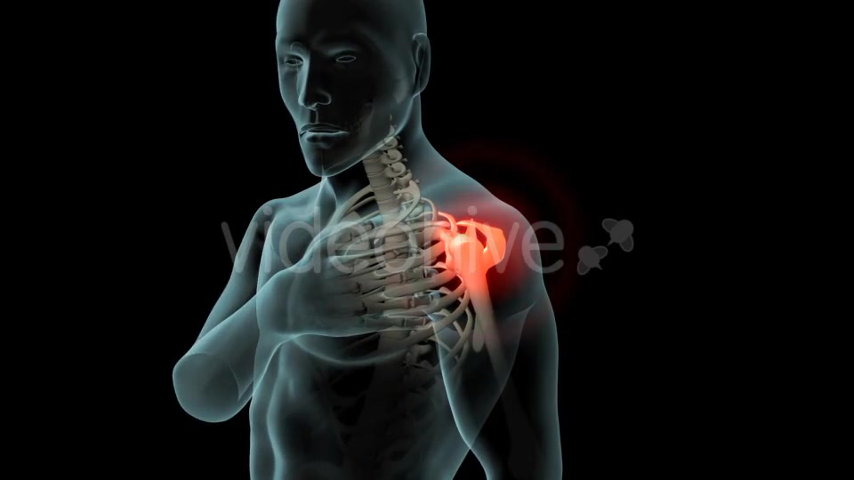 Shoulder Pain Videohive 21251423 Motion Graphics Image 5