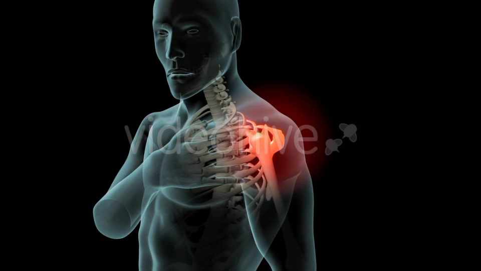 Shoulder Pain Videohive 21251423 Motion Graphics Image 6