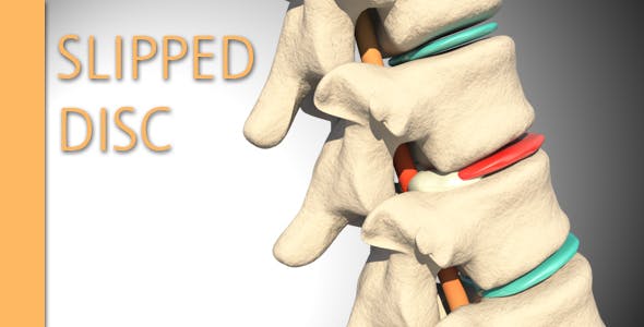 Slipped Disc - Videohive Download 14926997