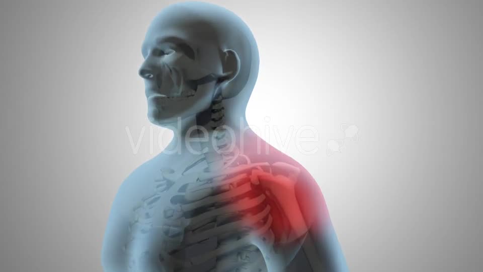 Surgical Treatment For The Rotator Cuff Tear Videohive 20535545 Motion Graphics Image 1