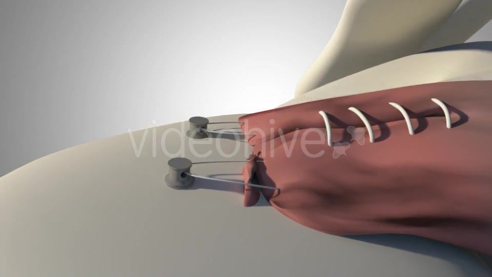 Surgical Treatment For The Rotator Cuff Tear Videohive 20535545 Motion Graphics Image 10