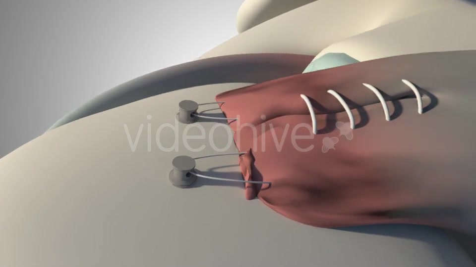 Surgical Treatment For The Rotator Cuff Tear Videohive 20535545 Motion Graphics Image 11