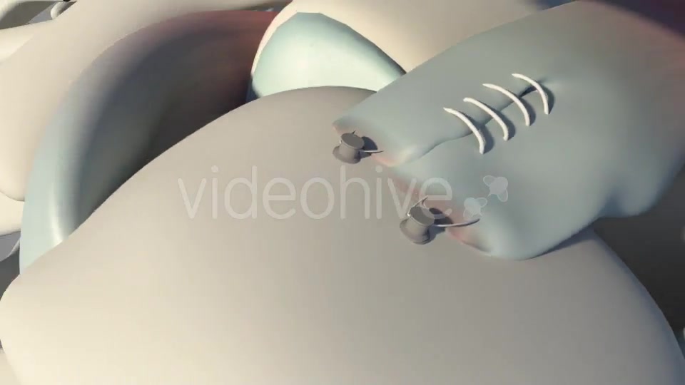 Surgical Treatment For The Rotator Cuff Tear Videohive 20535545 Motion Graphics Image 12