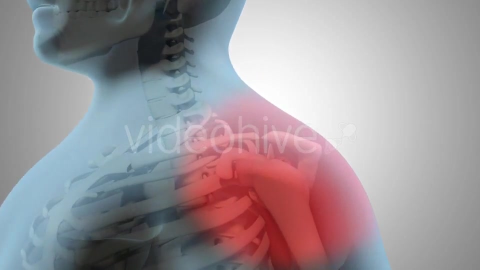 Surgical Treatment For The Rotator Cuff Tear Videohive 20535545 Motion Graphics Image 2