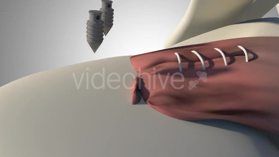 Surgical Treatment For The Rotator Cuff Tear Videohive 20535545 Motion Graphics Image 8