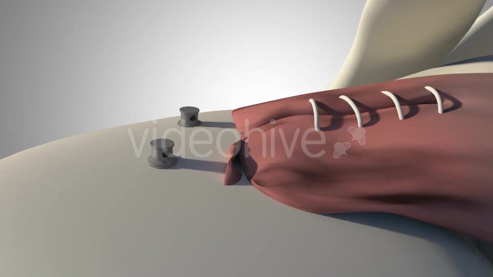Surgical Treatment For The Rotator Cuff Tear Videohive 20535545 Motion Graphics Image 9