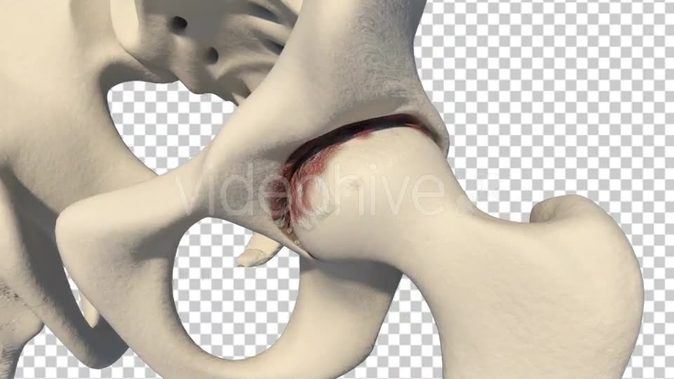 Total Hip Replacement Videohive 19511345 Motion Graphics Image 2