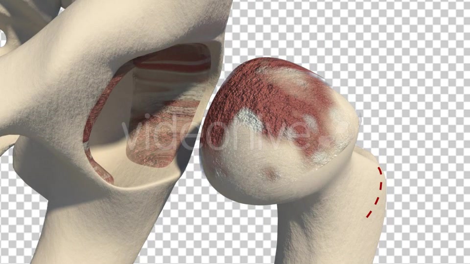 Total Hip Replacement Videohive 19511345 Motion Graphics Image 3