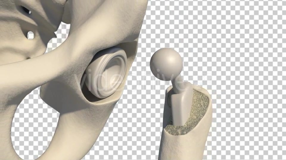 Total Hip Replacement Videohive 19511345 Motion Graphics Image 5