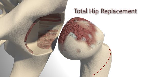 Total Hip Replacement - Videohive 19511345 Download