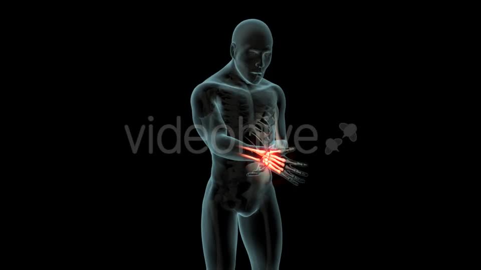 Wrist Pain Videohive 21281895 Motion Graphics Image 1