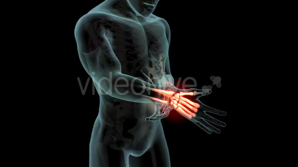 Wrist Pain Videohive 21281895 Motion Graphics Image 4