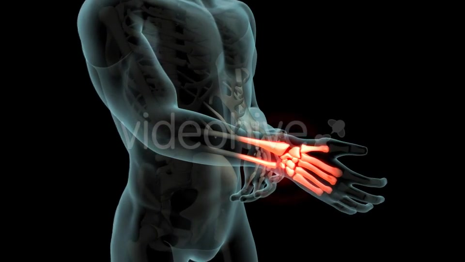 Wrist Pain Videohive 21281895 Motion Graphics Image 5