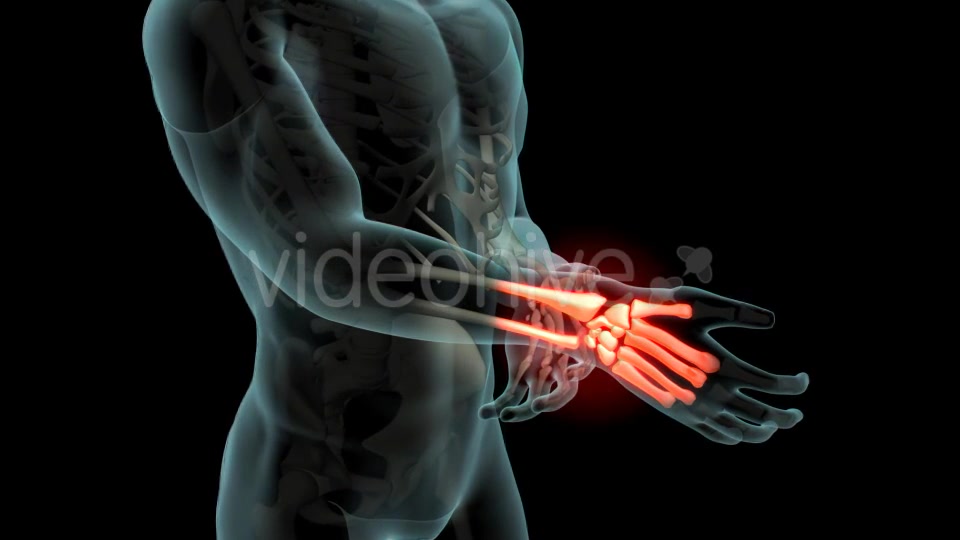 Wrist Pain Videohive 21281895 Motion Graphics Image 6